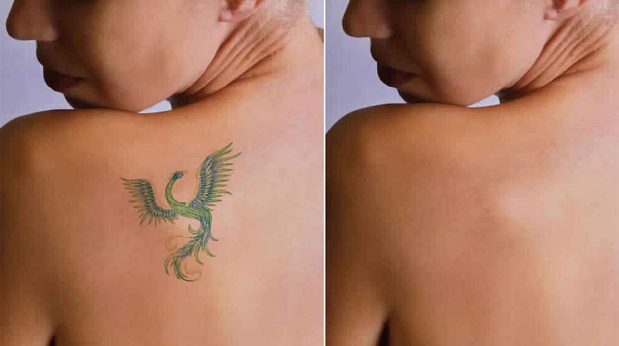 The Laser Tattoo Removal Healing Process  Removery